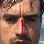 Nueva agresión homófoba: un joven recibe un fuerte cabezazo en la nariz en una playa canina de Málaga